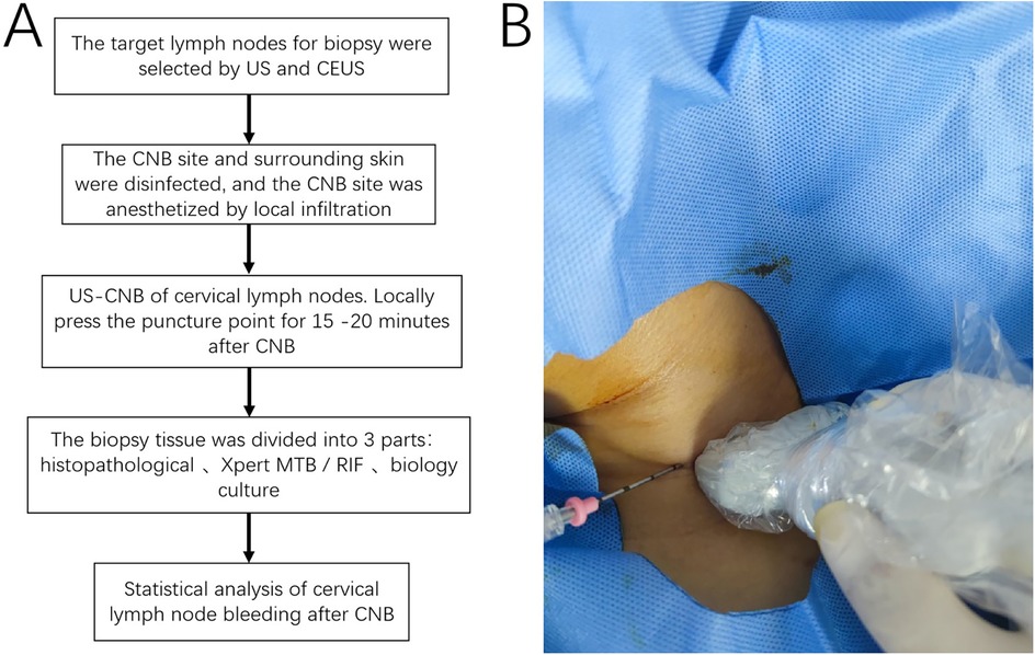 Diagram and procedure image of cervical lymph node biopsy. Panel A shows a flowchart detailing the biopsy process: selection with ultrasound, site disinfection, anesthesia, needle biopsy, tissue division, and statistical analysis of bleeding. Panel B depicts the actual ultrasound-guided procedure on a neck with local anesthesia.