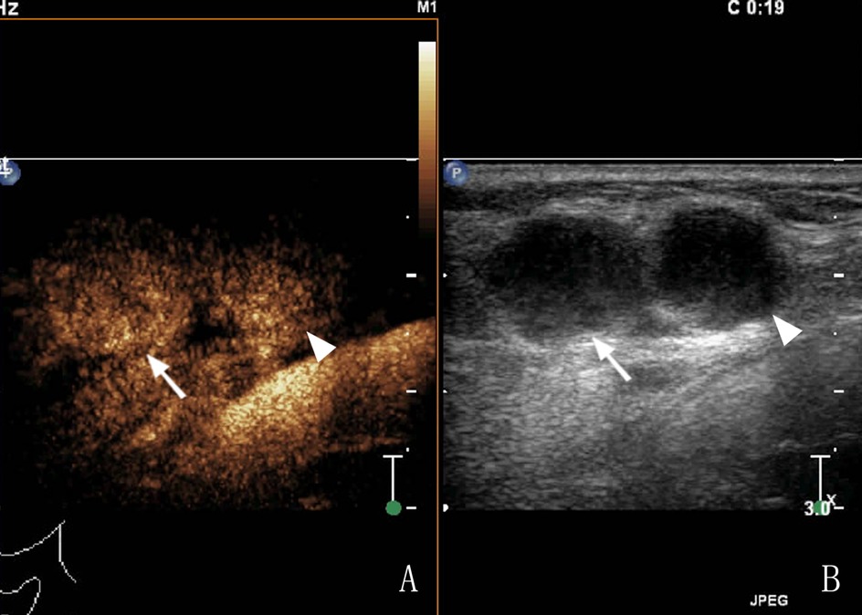 Comparison of two ultrasound images. Panel A shows a color-enhanced view with highlighted areas indicated by an arrow and arrowhead. Panel B presents a grayscale ultrasound with similar shapes marked by an arrow and arrowhead. Both panels emphasize specific regions within soft tissue structures.
