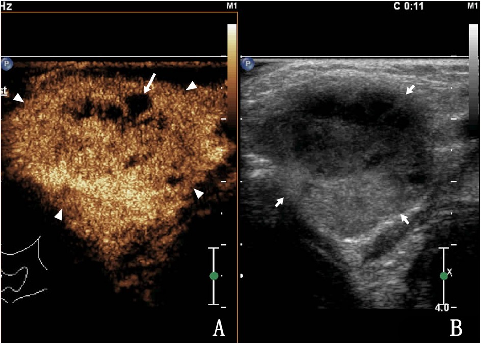 Ultrasound images showing two panels. Panel A depicts a contrast-enhanced ultrasound image with high intensity signals, highlighted by arrows and arrowheads indicating specific areas. Panel B shows a conventional grayscale ultrasound with arrows pointing to notable features for comparison. Both images emphasize differences in imaging techniques.