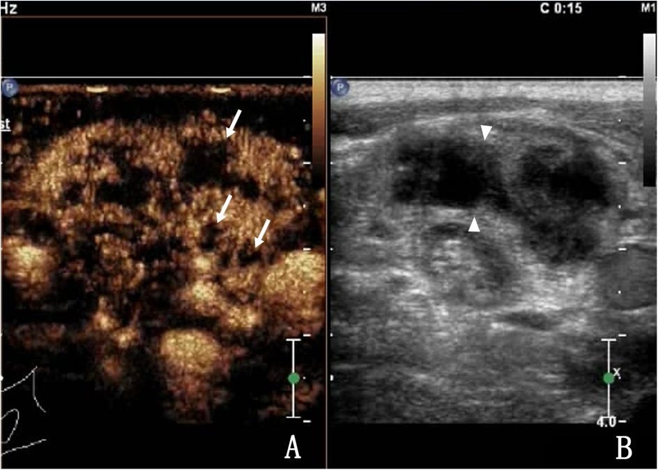 Medical ultrasound images showing two different scans. Image A features a more detailed, colored view with arrows pointing to specific areas. Image B is a grayscale scan with arrowheads indicating significant points. Both images share similar structures highlighting differences in visualization techniques.