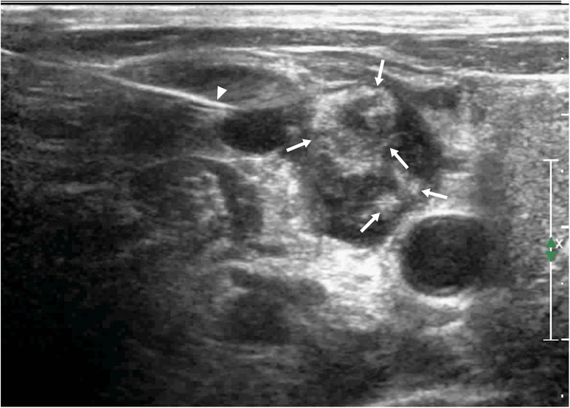 During the second needle entry of US-CNB, the triangle arrow shows the core needle bleeding was observed in the lymph node, and the abscess cavity was filled with fresh blood (arrow).
