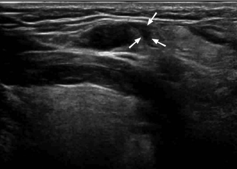 Ultrasound image showing a dark, round hypoechoic area in soft tissue with three white arrows pointing towards it, indicating a potential cyst or lesion beneath layers of muscle and skin.