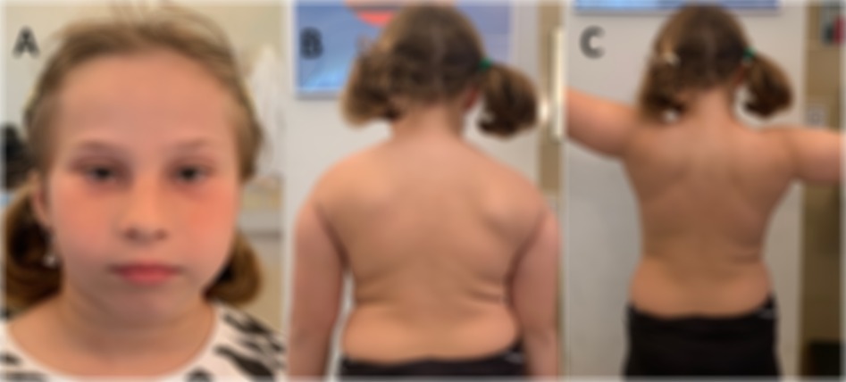 Three labeled images of a child. Image A shows the child's face from the front, with light freckling and pigtail hairstyle. Image B shows the child's upper back, displaying some adipose tissue. Image C shows the child’s back with arms extended, also highlighting adipose tissue.