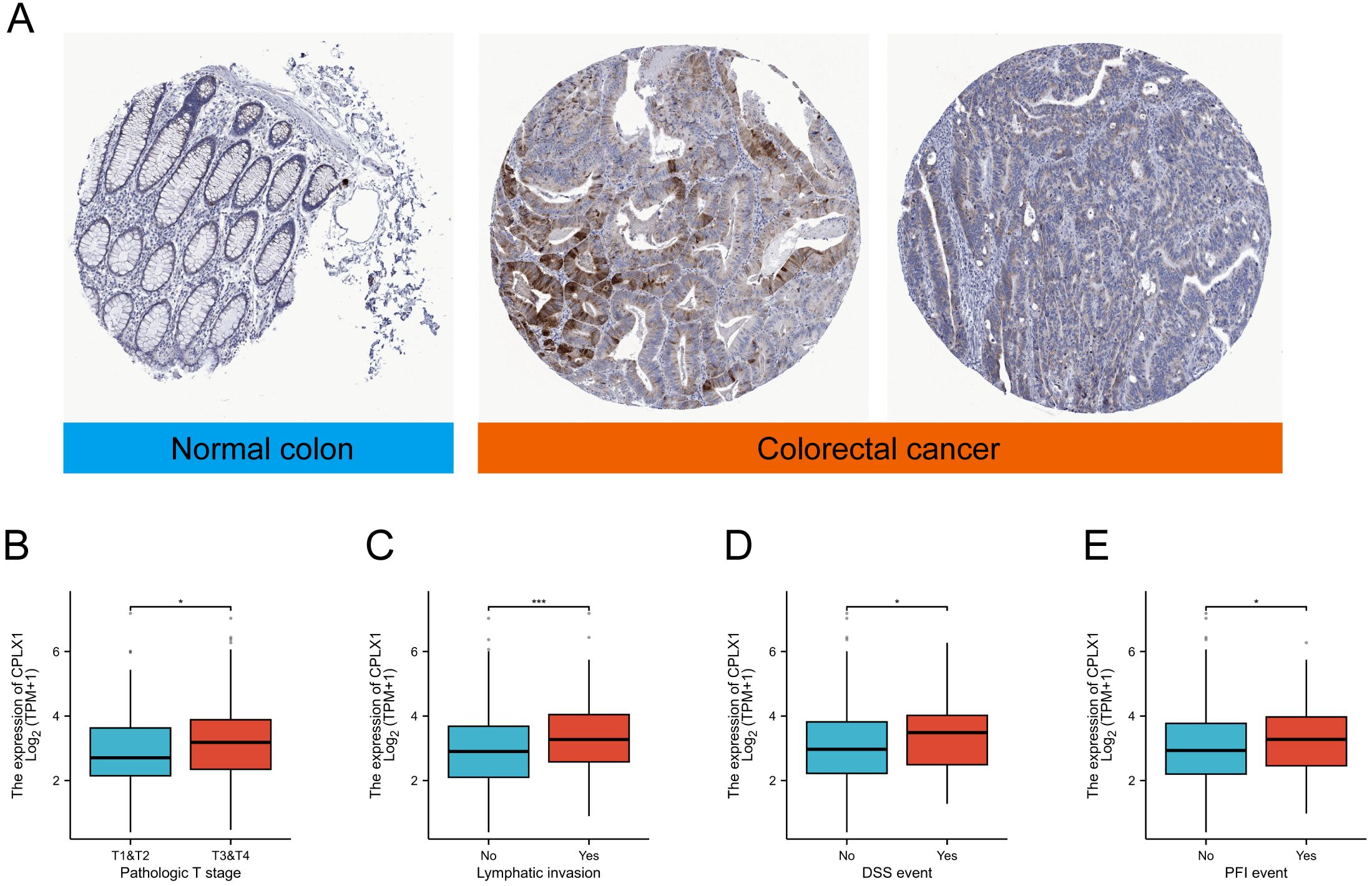 Histological sections show normal colon and colorectal cancer tissues, with notable differences in staining patterns. Box plots display comparisons of CPLX1 expression levels across various clinical categories: pathologic T stage, lymphatic invasion, DSS event, and PFI event, with statistical significance indicated by asterisks.