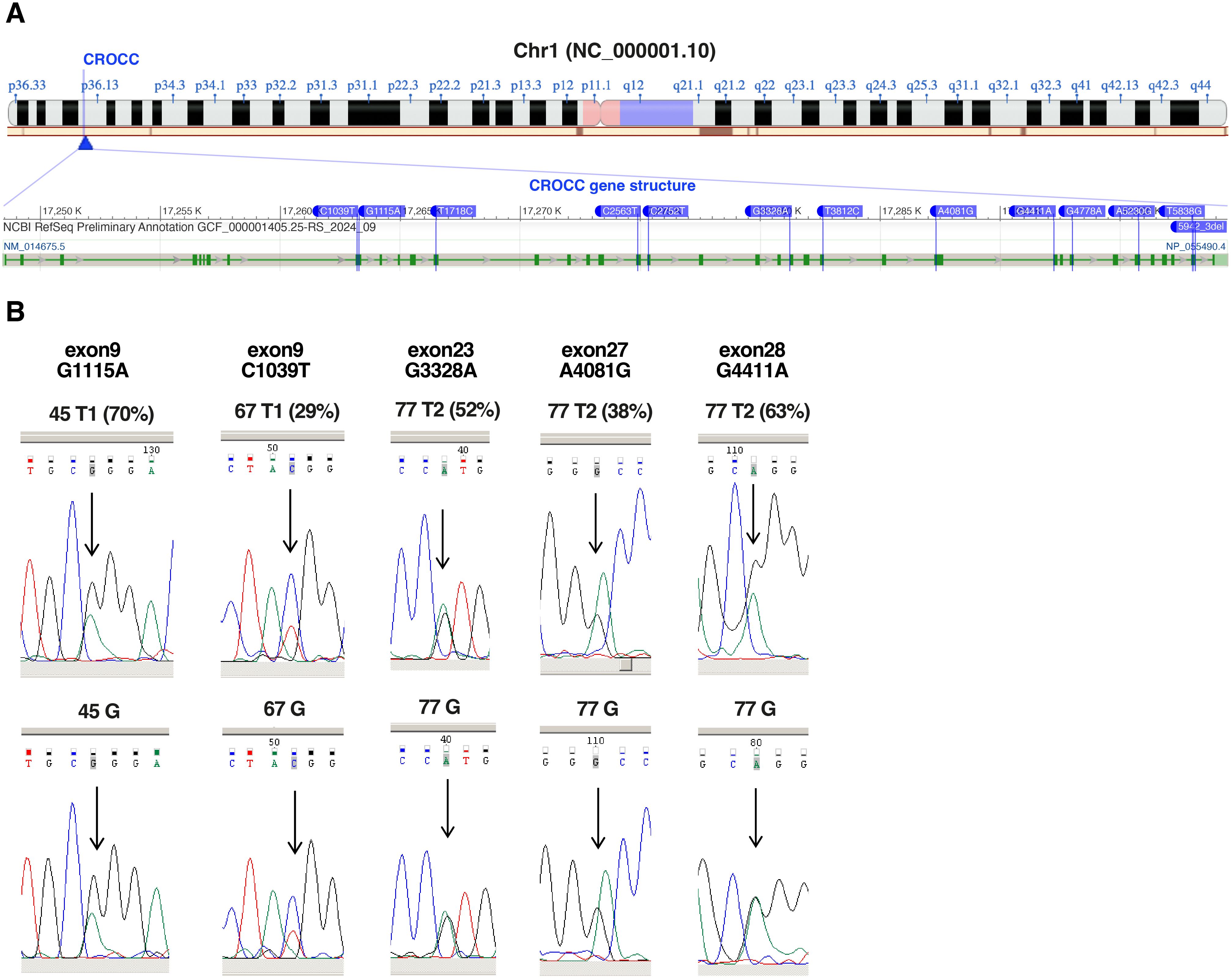 Genomic analysis of CROCC on chromosome 1. Panel A shows the chromosome with CROCC gene structure highlighting exons and genetic markers. Panel B provides electropherogram results for mutations in exons 9, 23, 27, and 28 with corresponding nucleotide changes and percentages.