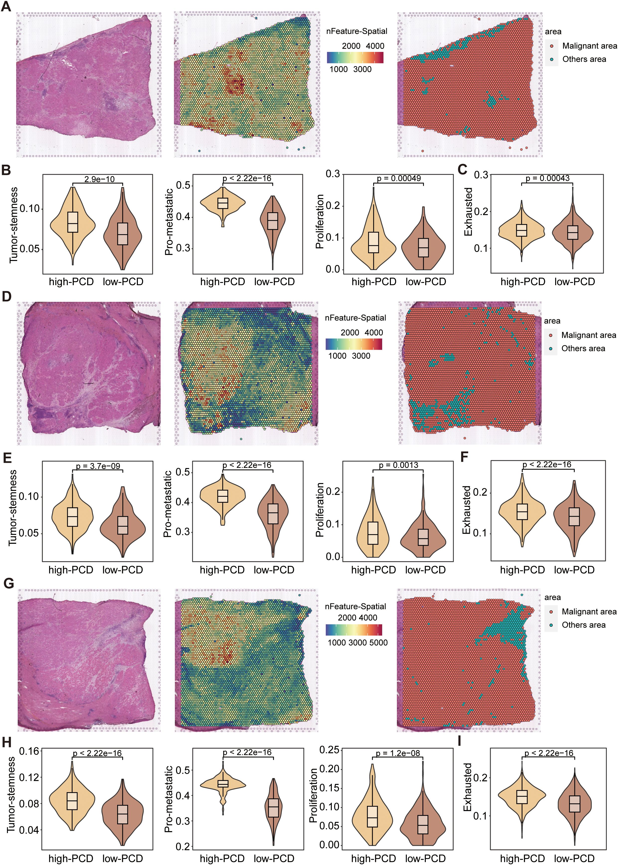 Histological images and spatial feature mappings show tumor tissues categorized as malignant or other areas. Adjacent graphs display violin plots comparing high-PCD and low-PCD groups on tumor stemness, pro-metastatic, proliferation, and exhaustion features, with p-values indicating statistical differences. Each set, labeled A through I, presents similar analyses.