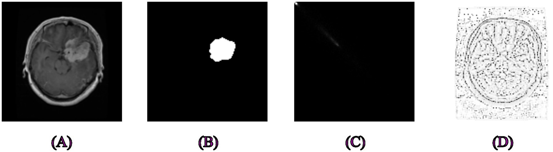 Four-panel image showing MRI and processed images of a brain: (A) Brain MRI scan showing a visible abnormality; (B) Segmented part of the abnormality highlighted in white; (C) Intensity projection with a faint diagonal line; (D) Edge-detected version of the MRI displaying contour lines.