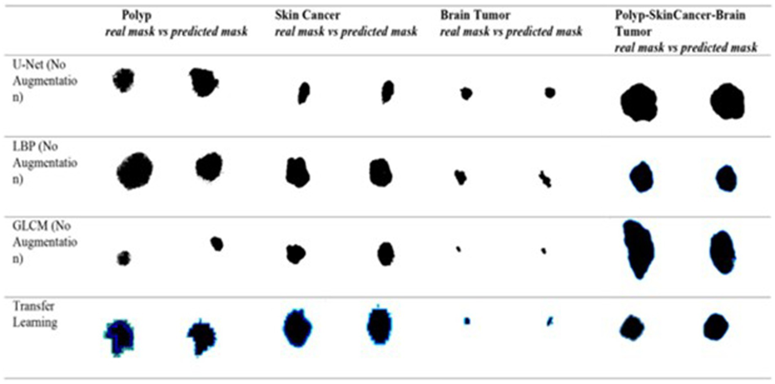Comparison of real and predicted masks for medical images using different techniques: U-Net, LBP, GLCM (all with no augmentation), and Transfer Learning. Categories include polyp, skin cancer, brain tumor, and a combined class. Differences between real and predicted masks are visible across methods.