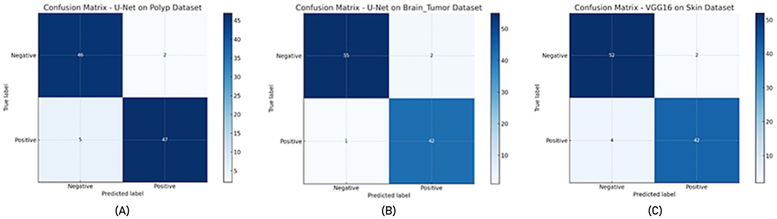 Three confusion matrices compare model performance on different datasets. (A) U-Net on Polyp Dataset: 46 true negatives, 2 false positives, 5 false negatives, 47 true positives. (B) U-Net on Brain Tumor Dataset: 55 true negatives, 2 false positives, 1 false negative, 42 true positives. (C) VGG16 on Skin Dataset: 52 true negatives, 2 false positives, 4 false negatives, 42 true positives.