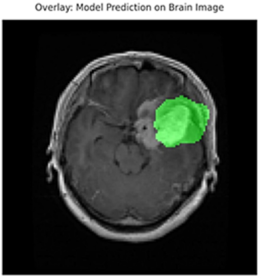 MRI scan of a brain with a highlighted green area on the right side indicating a model's prediction.