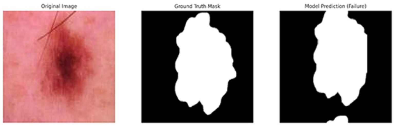 Three-panel image showing skin lesion analysis. The left panel depicts an original image of a dark skin lesion on a light background. The middle panel displays a ground truth mask with a white shape representing the lesion against a black background. The right panel shows a failed model prediction with a similar white shape but with inaccuracies against a black background.