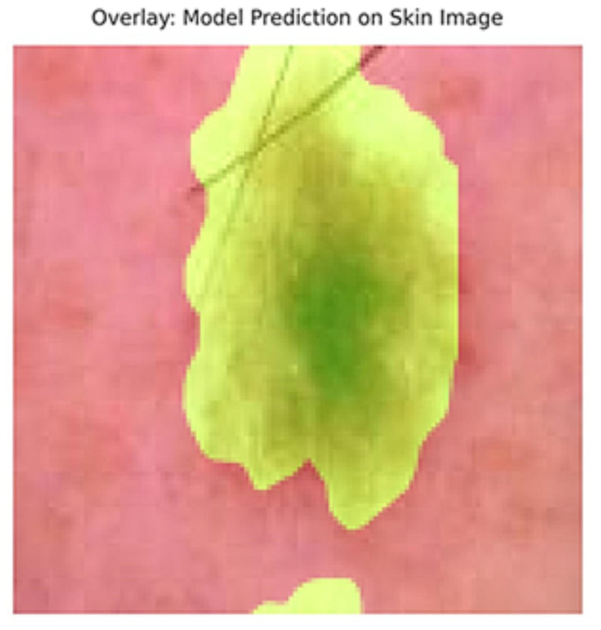 Color-enhanced skin image with a large green and yellow overlay indicating a model prediction area against a pinkish background.