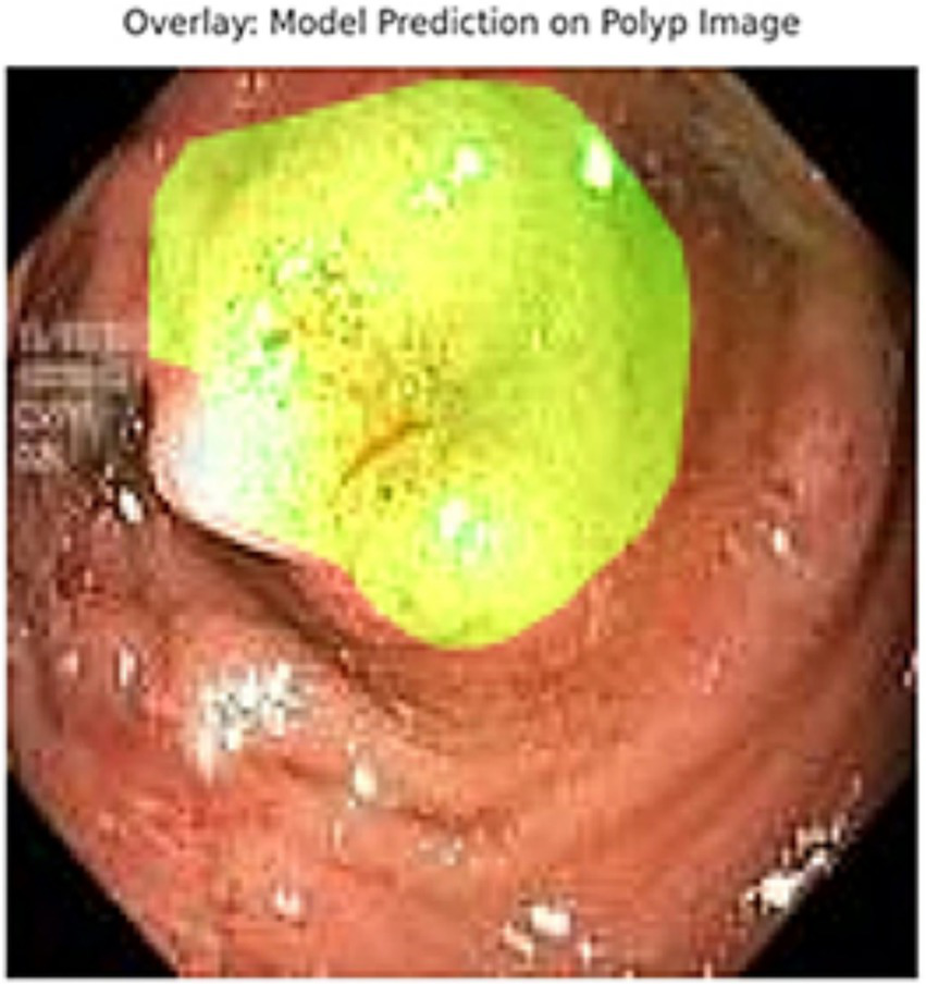 Endoscopic image showing a polyp in the colon. A bright green overlay highlights the polyp area as identified by a model prediction system, with surrounding tissue appearing in shades of pink and red.