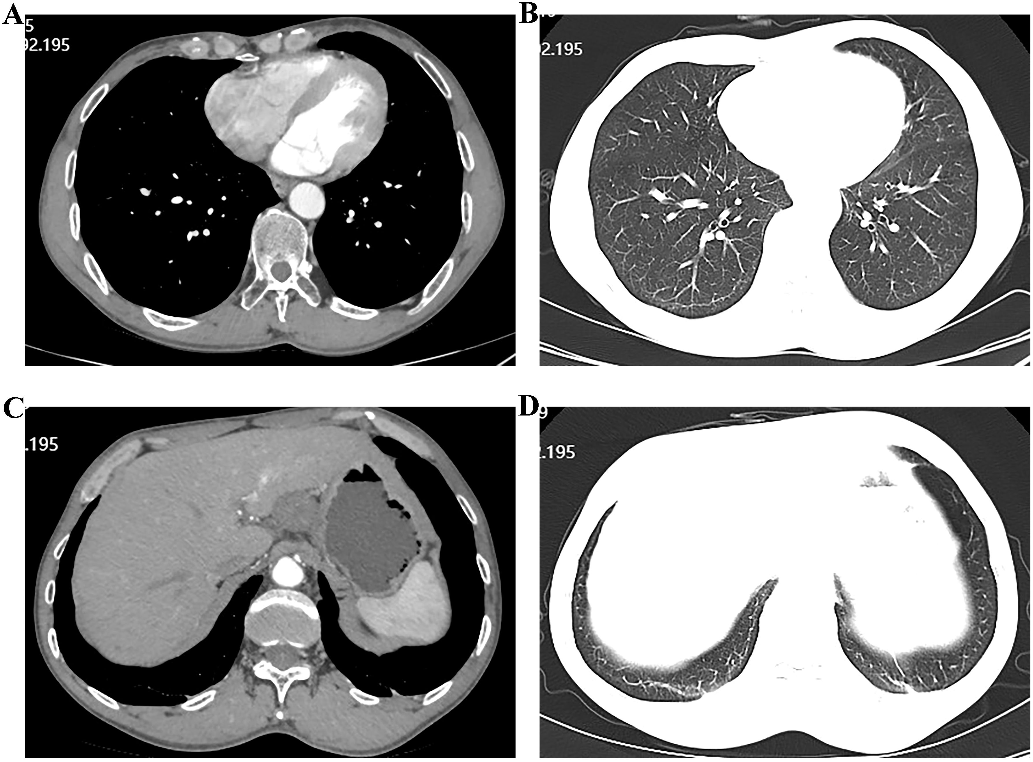Four-panel radiographs show different cross-sections of the chest and abdomen. Panel A displays a thoracic CT with contrast highlighting the heart and surrounding vessels. Panel B shows a lung window view with detailed pulmonary structures. Panel C is a CT scan of the upper abdomen focusing on the liver and stomach. Panel D features a lung base scan, accentuating the lower lobes.