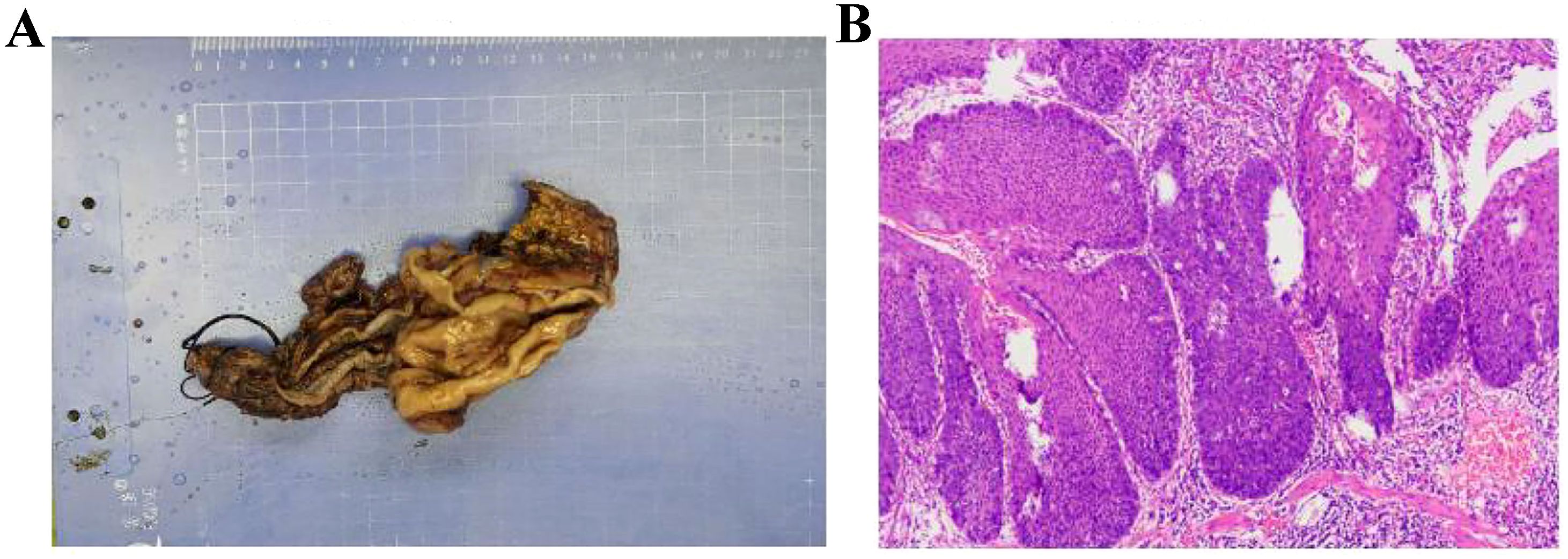 Panel A shows a resected segment of the gastrointestinal tract, placed on a grid-lined surface for measurement. Panel B presents a histological section under a microscope, displaying tissue with purple and pink staining and distinct cellular structures.