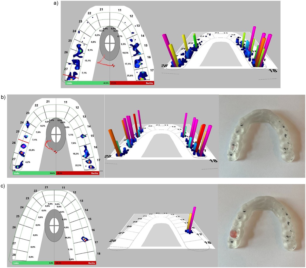 Three panels comparing the pressure point distribution under three different occlusal conditions. (a) shows a diagram with vertical bars that reflect the pressure point distribution and strength on the maxillary dental arch. (b) demonstartes a more harmonious bar distribution and height when wearing a harmonic occlusal splint. (c) shows that the bars format themselves punctually at the location of the simulated interfering contact.