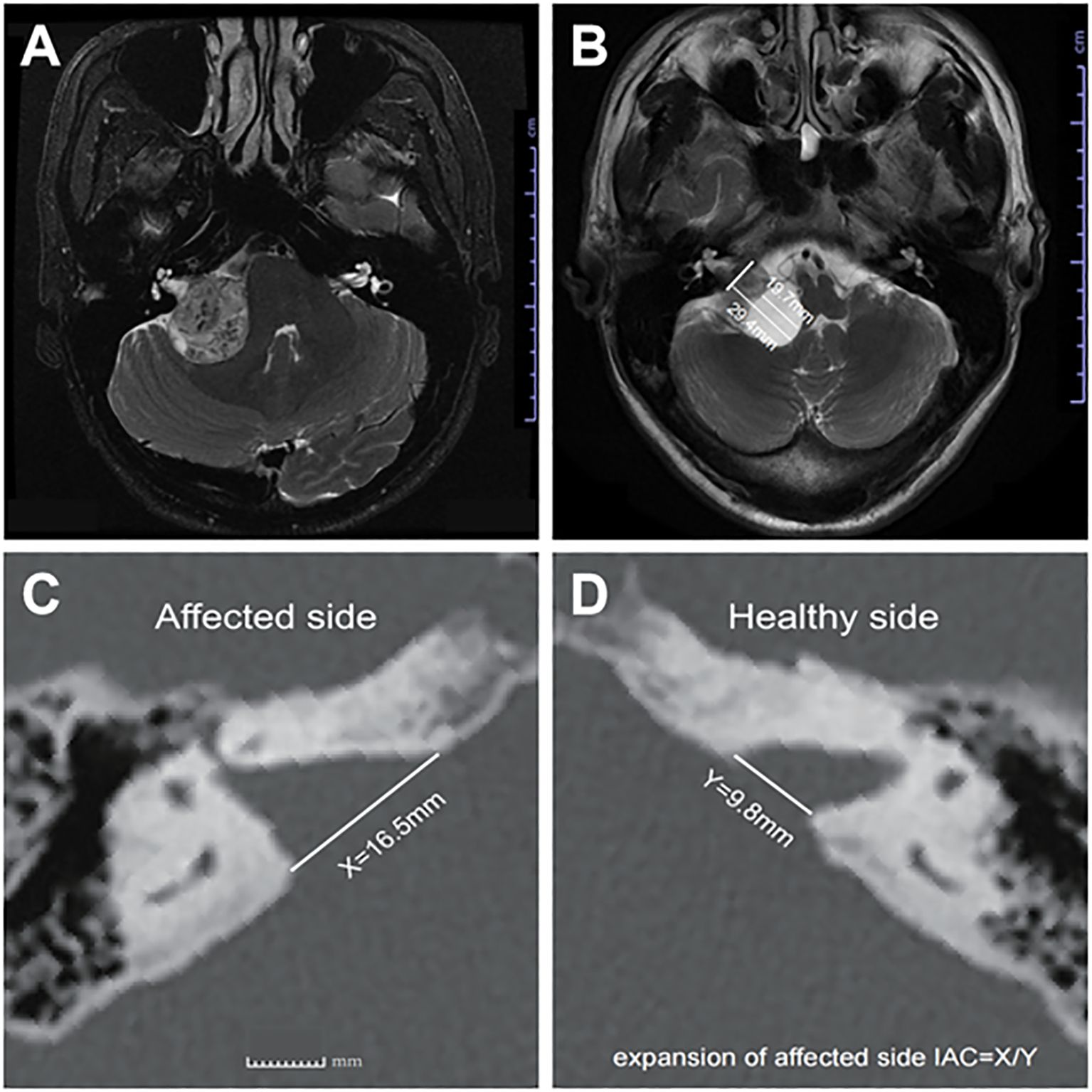MRI images demonstrating differences between affected and healthy sides. Image A and B show axial brain scans with a noticeable asymmetry. C depicts a measurement on the affected side with a length of 16.5 millimeters, while D shows the healthy side with a measurement of 9.8 millimeters, indicating expansion on the affected side.