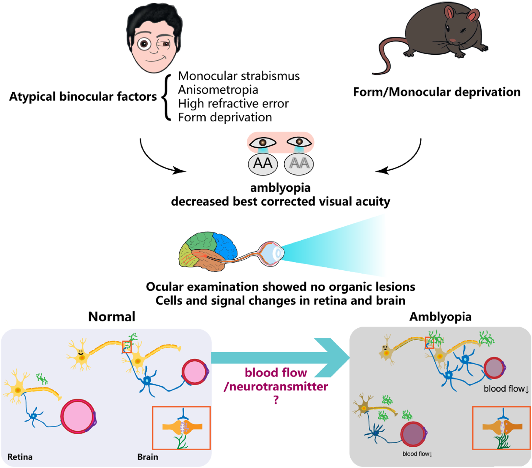 Illustration depicting the causes and effects of amblyopia. Atypical binocular factors such as monocular strabismus and anisometropia lead to amblyopia with decreased visual acuity. An eye exam shows no organic lesions. Diagrams compare normal and amblyopic retinas and brains, hypothesized that cerebral blood flow and neurotransmitter activity play critical roles in the process.