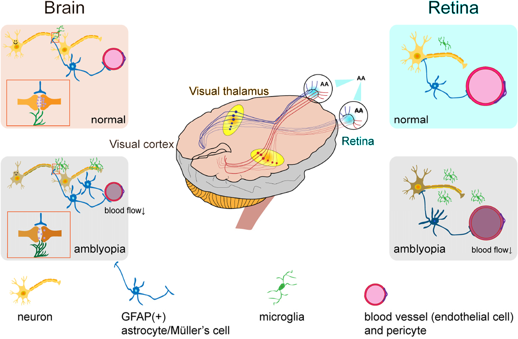 Diagram illustrating a hypothesis of the neural and vascular differences in the brain and retina between normal conditions and amblyopia. In the brain, normal and amblyopic states show variations in neurons, GFAP(+) astrocytes/Müller’s cells, microglia, and blood vessel structures with differences in blood flow. A central image represents the visual cortex and thalamus pathways, with labeled components like neurons and blood vessels.