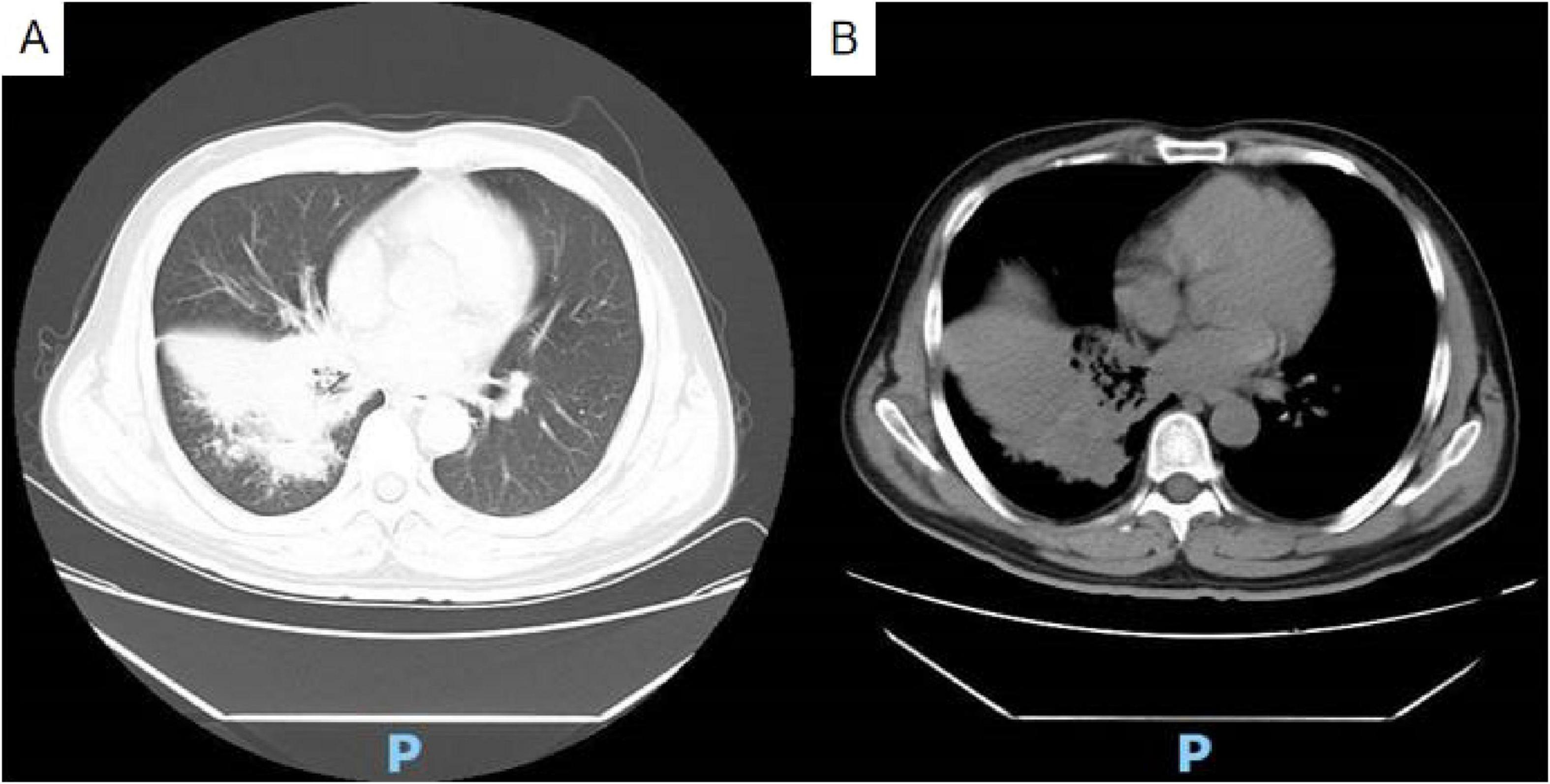 CT scans of the thorax showing two different slices. Image A displays the lungs with a visible white area indicating a possible abnormality in the left lung. Image B shows a different view with more dense regions, highlighting the heart and surrounding structures. Both images are labeled with “P” at the bottom of the image, where “P” refers to posterolateral.