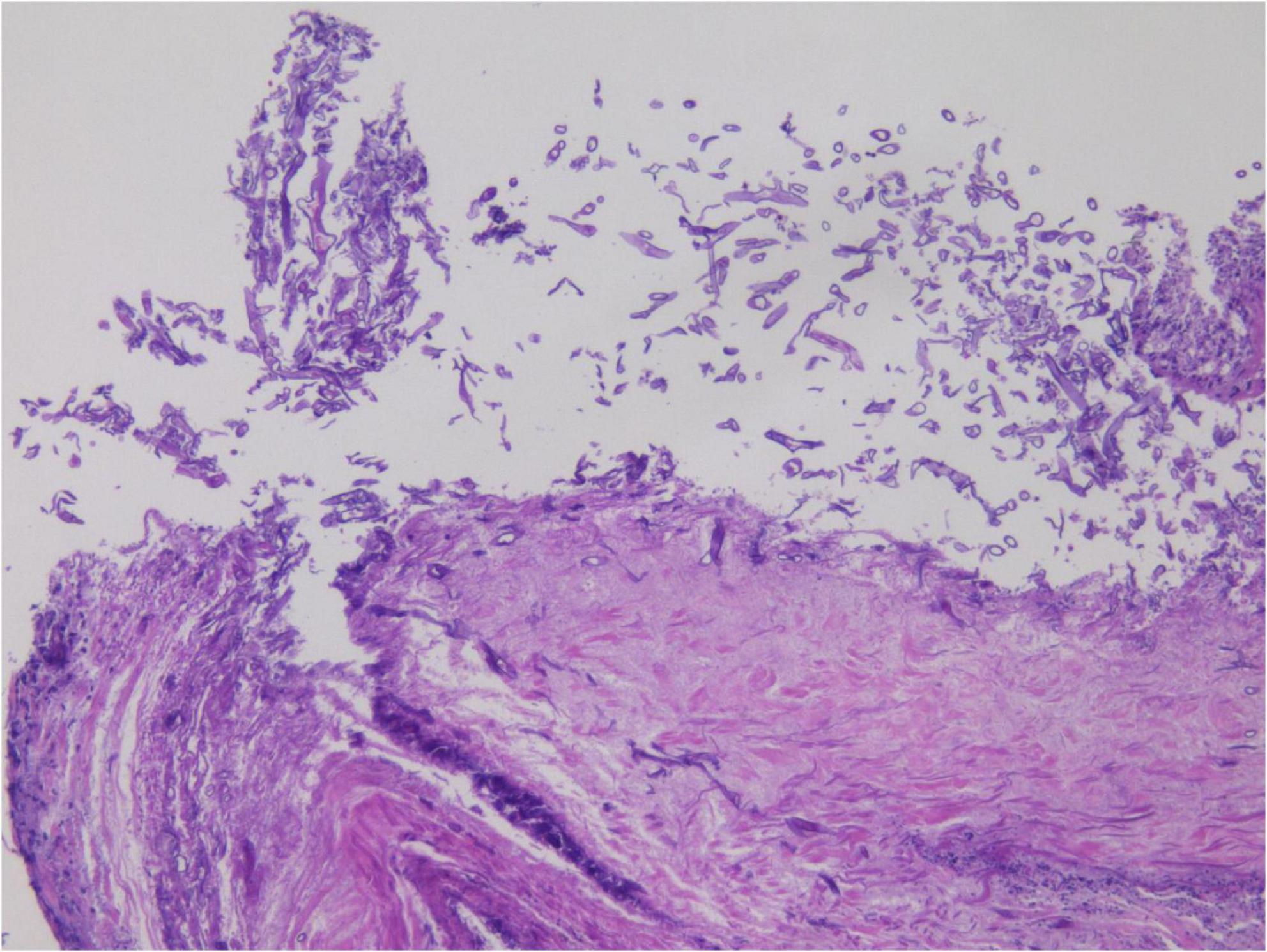Histological image showing a section of skin tissue stained with purple hues. The lower half displays dense tissue, possibly the dermis, while the upper half features dispersed, irregularly shaped cells or structures, suggesting possible epidermal layer or foreign material.