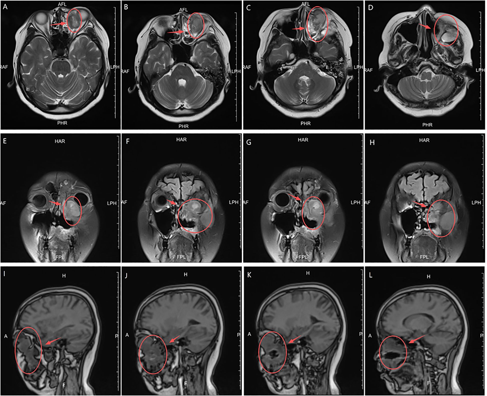 MRI images of a brain in different sections display abnormalities outlined in red circles. Panels A to D show axial views, E to H show coronal views, and I to L show sagittal views. Each red circle denotes specific areas of interest, indicating potential pathology. Labels such as AFL, PHR, HAR, LPH, and FPL mark orientations and anatomical references.