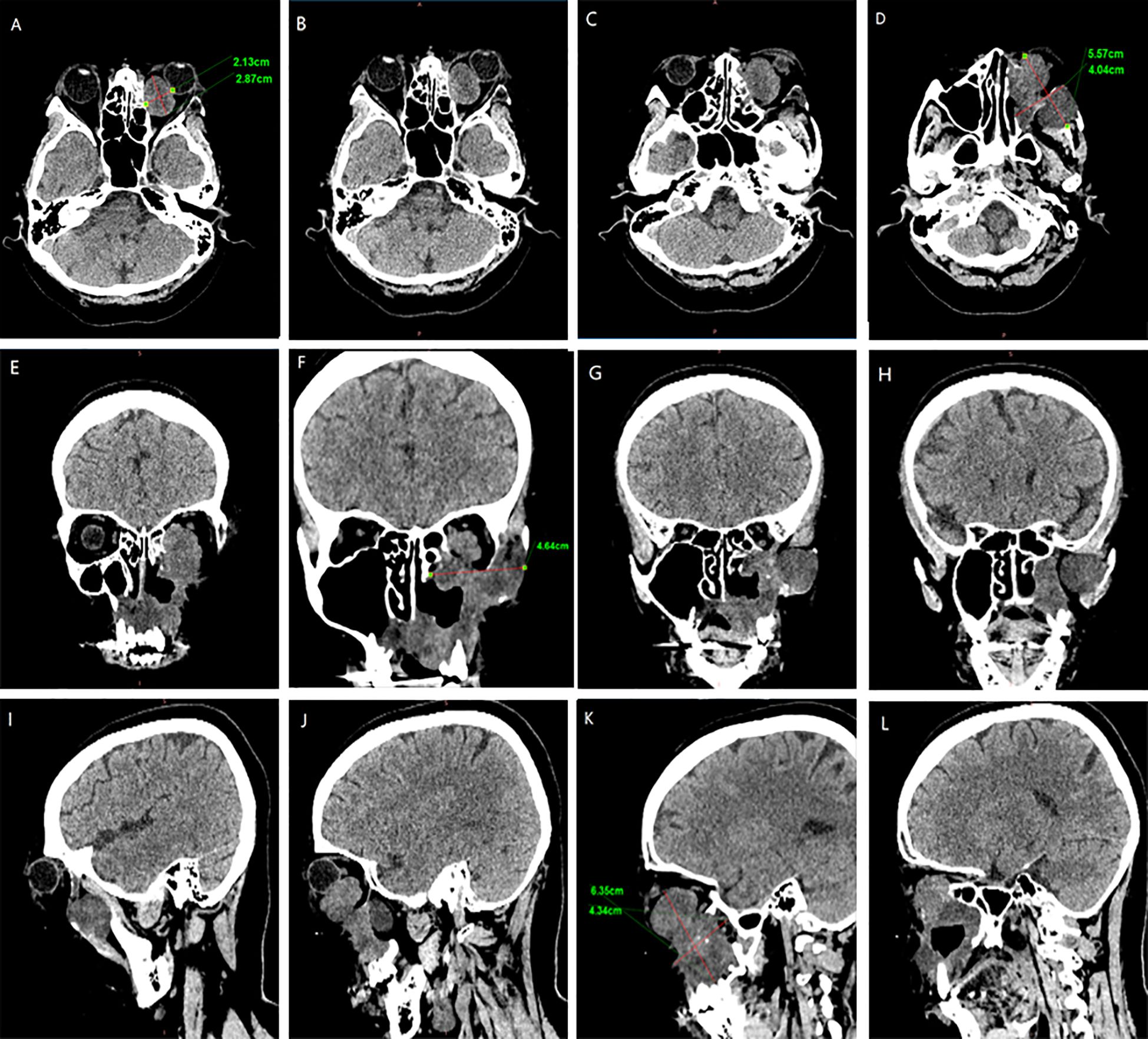 CT scan images showing various axial, coronal, and sagittal views of a brain. Panels A to D display axial slices with measurements indicating sizes of certain features. Panel A shows dimensions of 2.13 cm and 2.87 cm, while Panel D indicates 5.57 cm and 4.04 cm. Panels E to H represent coronal views, with Panel F detailing a 4.66 cm measurement. Panels I to L are sagittal views, with Panel K showing measurements of 8.35 cm and 4.34 cm. Highlighted areas suggest regions of interest within the brain.