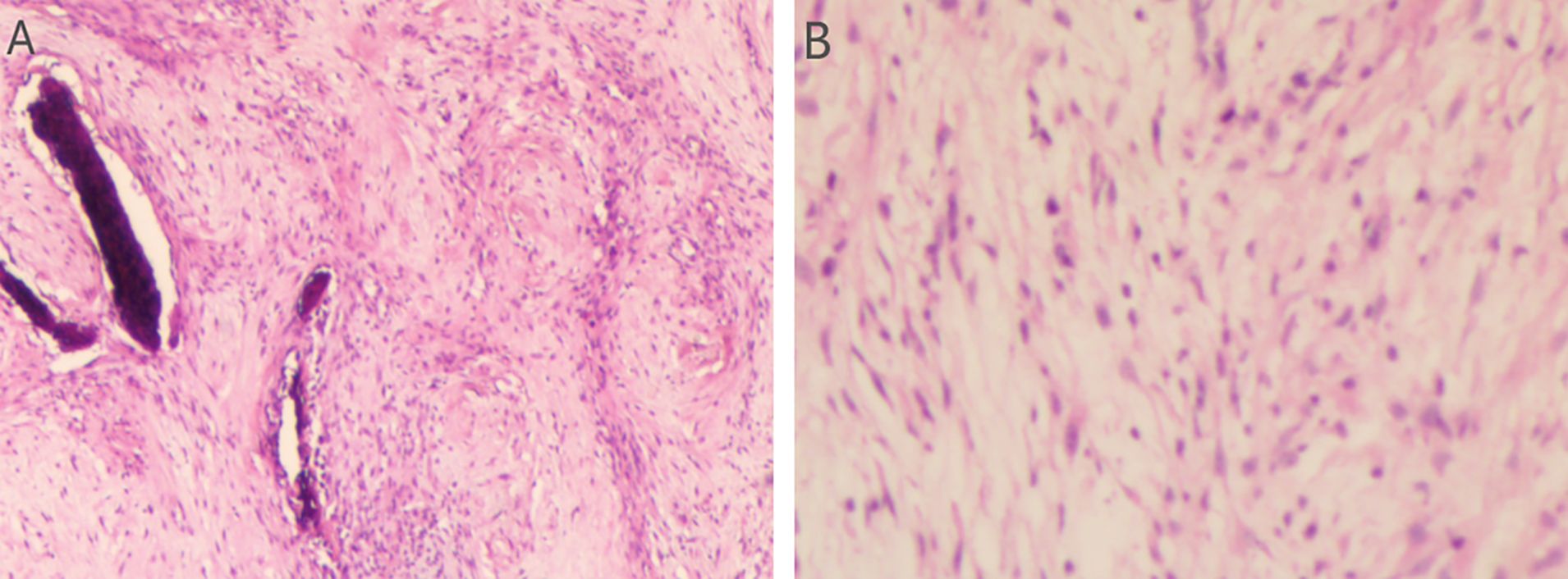 Two microscopic images labeled A and B depict tissue sections stained in pink and purple. Image A shows irregularly shaped darker elongated structures within a pink matrix. Image B displays a more homogeneous distribution of cells with fewer dark structures.