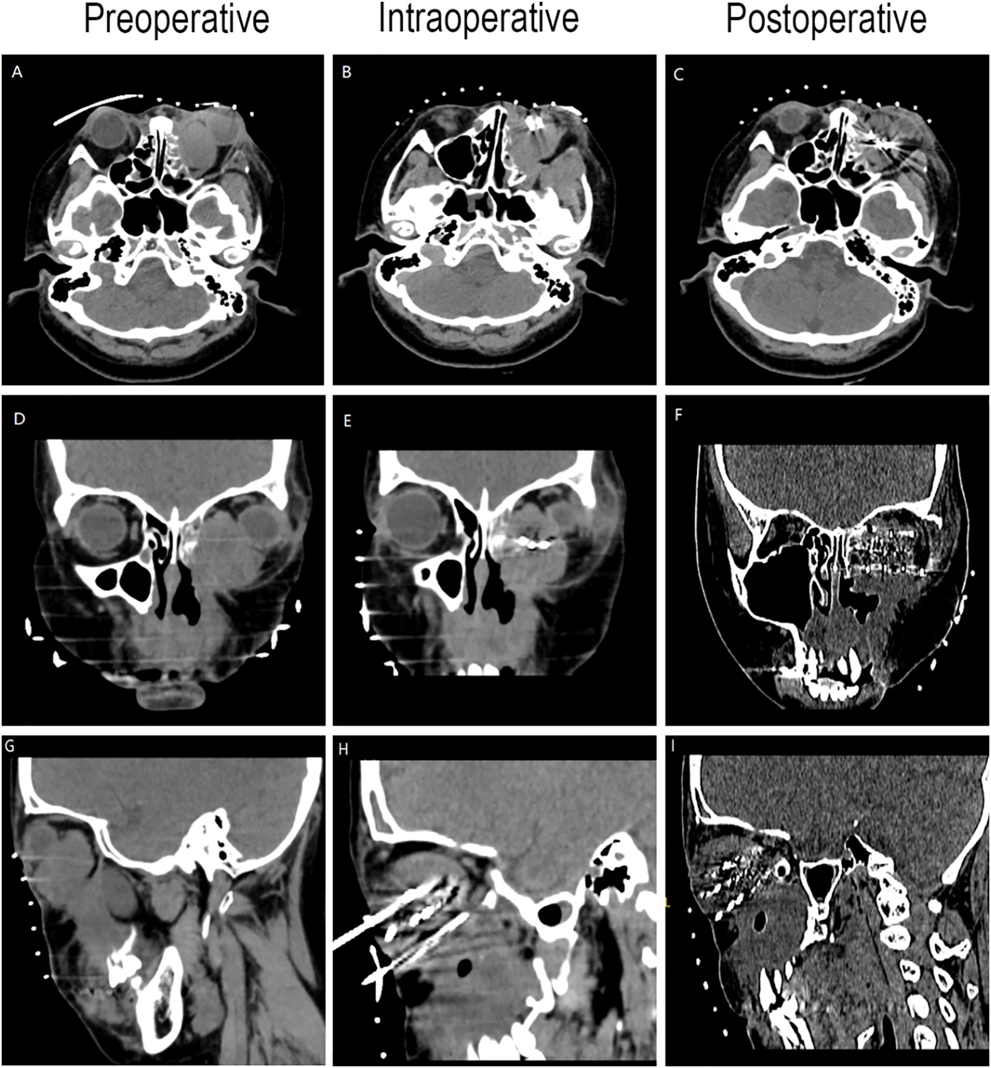 CT scans depict the preoperative, intraoperative, and postoperative stages. Panels A, B, and C show axial views; D, E, and F are frontal views; G, H, and I are sagittal views. Differences in bone and tissue structure are evident across the stages, highlighting surgical changes.