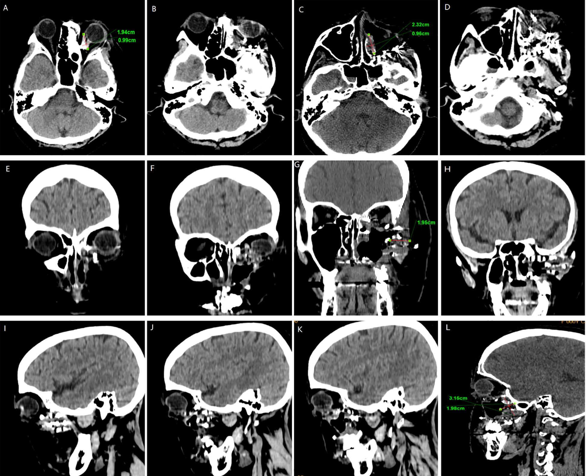 Fourteen medical CT scan images of the head, displayed in three rows, labeled A through L. Measurements of growths within the scans are marked in green on certain images. The scans are shown in axial, coronal, and sagittal views, displaying different anatomical sections for detailed examination.