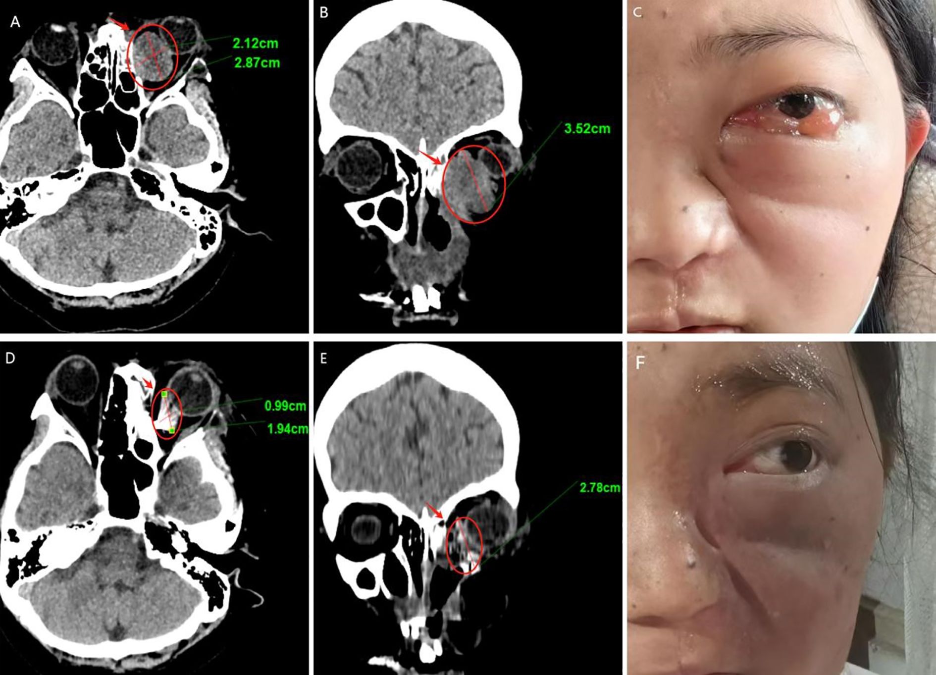 Medical images showing a patient's cranial CT scans in axial (A, D) and coronal (B, E) views, highlighting a mass near the right eye. Dimensions are noted as 2.12 cm, 2.87 cm, 3.52 cm, 0.99 cm, 1.94 cm, and 2.78 cm. Photographs (C, F) display significant swelling and discoloration around the patient's right eye.