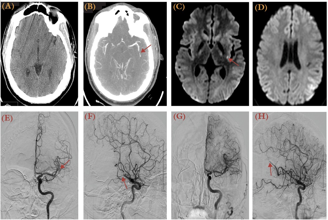 Multiple brain imaging scans are shown: (A) Initial CT scan. (B) CT angiogram with an arrow marking a vessel. (C) DWI scan with an arrow indicating an area of interest. (D) Additional DWI scan. (E) Angiogram with an arrow pointing to a specific vessel. (F) Another angiogram with an arrow marking a notable feature. (G) Clear angiogram of cerebral vessels. (H) Angiogram with an arrow indicating a vessel of interest.
