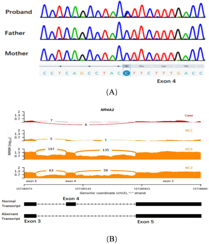 Panel (A) displays DNA sequencing chromatograms for the proband, father, and mother, highlighting a cytosine (C) to thymine (T) mutation in exon 4. Panel (B) shows RNA sequencing read coverage across exons three, four, and five of the NR4A2 gene, with a comparison between the case and controls NC1, NC2, and NC3. It also includes a schematic of normal and aberrant transcripts, indicating exon usage differences.