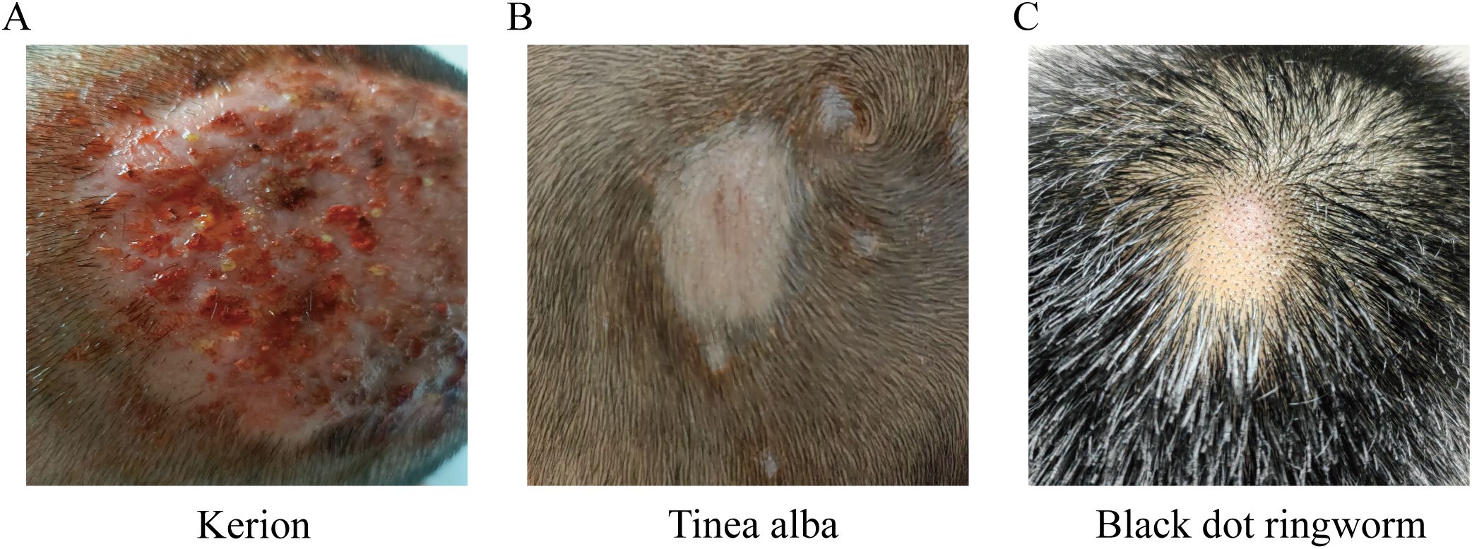 Panel A shows a scalp with red, inflamed patches indicative of kerion. Panel B illustrates a scalp with a lighter, round patch suggesting tinea alba. Panel C presents a scalp with a small circular area of hair loss, typical of black dot ringworm.