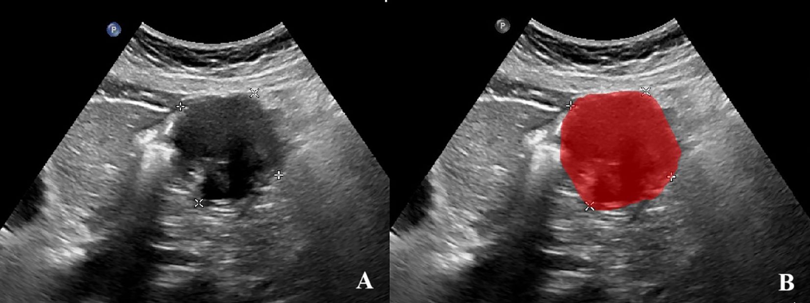 Side-by-side ultrasound images labeled A and B. Image A shows a dark, oval area in the center with crosshair markers, indicating a mass or structure. Image B shows the same area highlighted in red, with similar crosshair markers, emphasizing the identified region.