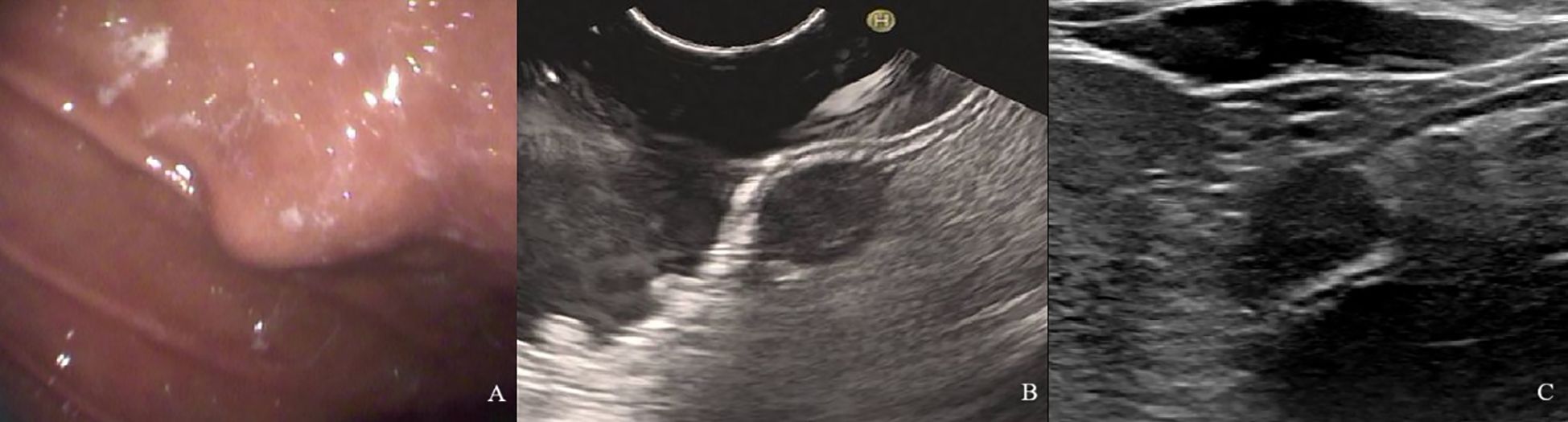 Panel A shows an endoscopic view of the duodenum's wall, revealing the ampulla. Panel B displays an endoscopic ultrasound image of the ampullary region. Panel C presents an ultrasound image showing a bile duct stone.