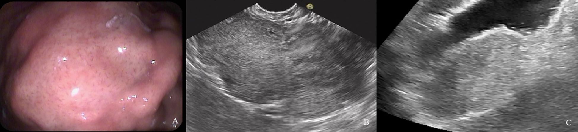 Panel A shows a close-up of a smooth, pinkish tissue surface, possibly an endoscopic view. Panel B is an ultrasound image displaying a grainy texture with varying shades of gray, likely illustrating a cross-section of internal tissue. Panel C is another ultrasound image with similar texture, emphasizing different tissue layers or structures.