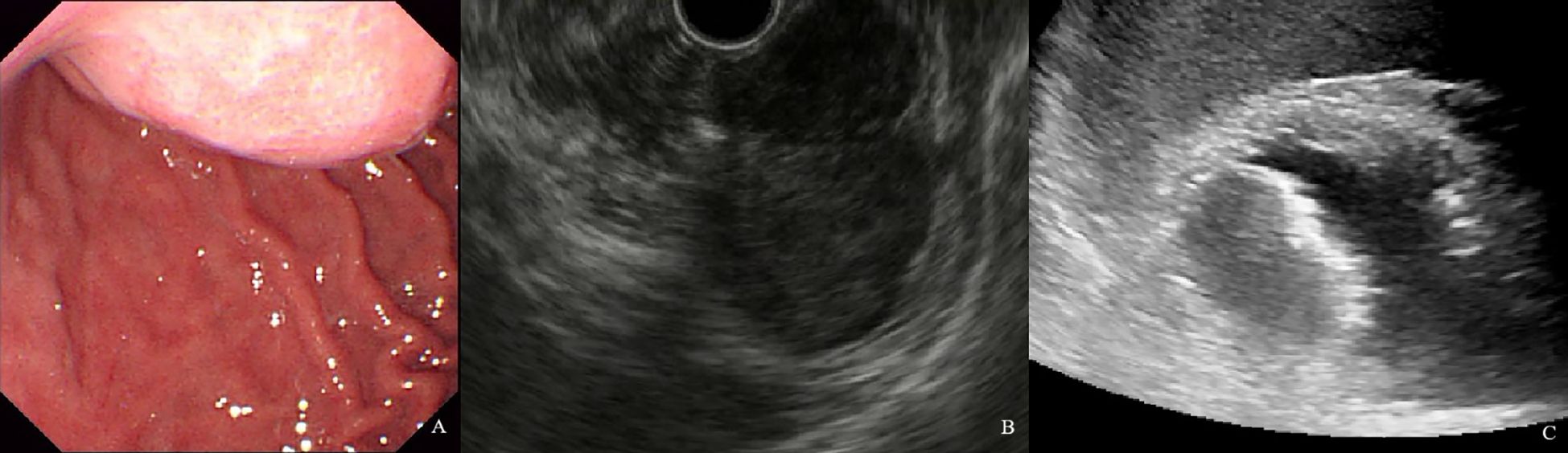 Three medical images are shown. Image A is an endoscopic view of the stomach lining, displaying a smooth, red surface. Image B is an ultrasound showing a circular structure with varying shades of gray. Image C is another ultrasound displaying a similar circular structure with a darker center, representing a possible cyst or lesion.