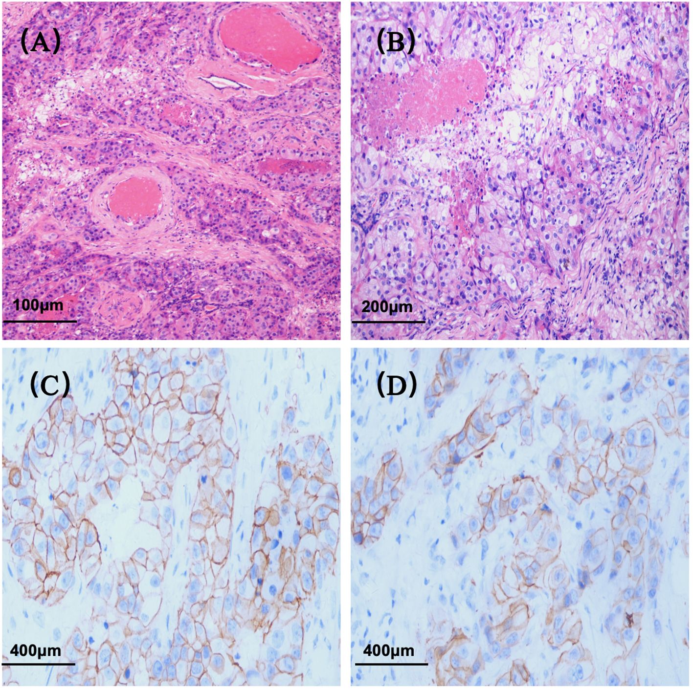 Microscopic images of tissue samples. (A) Shows a dense arrangement of cells with a pink staining, scale at one hundred micrometers. (B) Displays a similar sample at two hundred micrometers, less dense. (C) Exhibits a network of cells outlined in brown, scale at four hundred micrometers. (D) Similar to C, with a lighter blue background and distinct brown cell outlines, scale at four hundred micrometers.