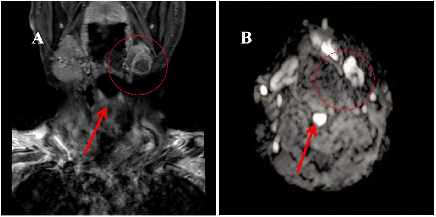 MRI images labeled A and B. Image A shows a coronal view of a head with a red circle and arrow highlighting a specific area. Image B presents an axial view with a red circle and arrow emphasizing another area. Both images focus on the regions indicated by the arrows and circles.