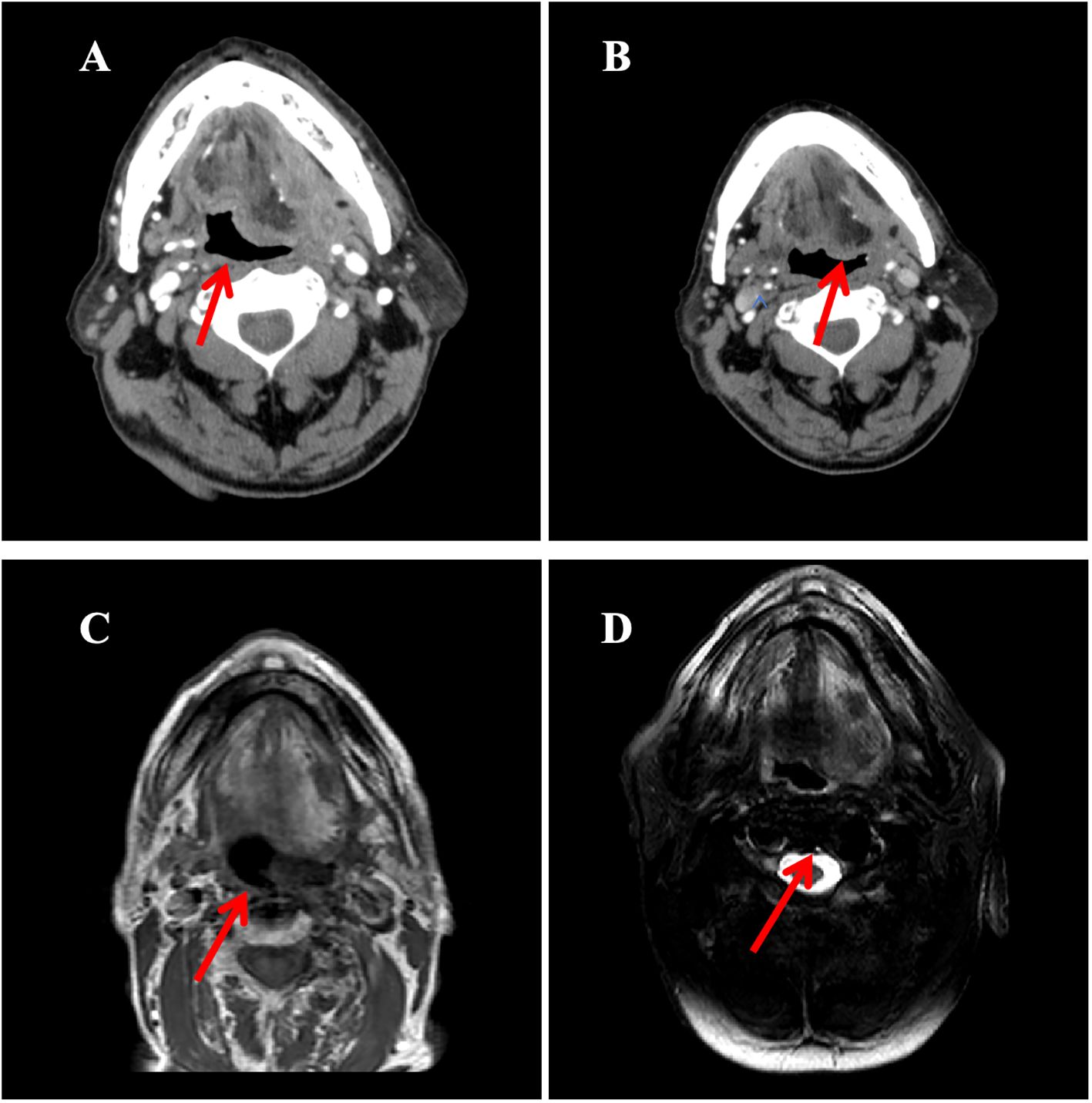 CT and MRI scan images of the neck in four panels labeled A to D. Each panel shows a cross-sectional view with a red arrow indicating an area of interest, possibly a lesion or abnormality, near the midline of the neck.