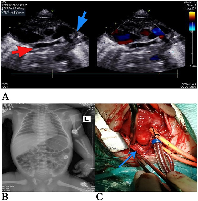 Ultrasound A shows a cystic mass with color Doppler indicating blood flow; red and blue arrows point to specific areas. X-ray B displays a frontal view of a child's torso, identifying skeletal and soft tissue structures. Image C captures a surgical procedure with a blue arrow indicating a surgical instrument or area of focus.