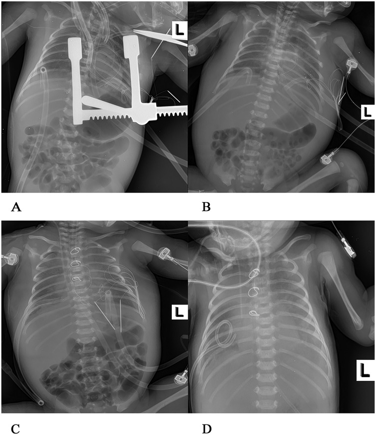 Four X-ray images labeled A, B, C, and D show a pediatric thoracic region. A: External fixation device visible. B: Intubation and various tubes present. C: Multiple lines and tubes in chest area. D: Clear view of ribs, spine, and tubes. All images have an \