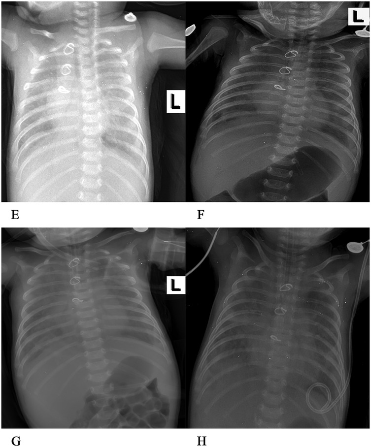 X-ray images of an infant's chest in four different views, labeled E, F, G, and H. The skeletal structures, including ribs and spine, are visible, with markers indicating left (L) on each image. Details such as bones and internal features are outlined in varying degrees of contrast.