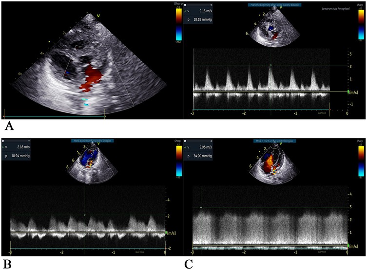 Three images labeled A, B, and C displaying echocardiogram data. Image A shows red and blue Doppler flow with a velocity of 2.13 meters per second and pressure of 18.18 millimeters mercury. Image B shows blue and red Doppler flow with a velocity of 2.18 meters per second and pressure of 18.94 millimeters mercury. Image C shows red Doppler flow with a velocity of 2.95 meters per second and pressure of 34.90 millimeters mercury. Each image includes a spectral Doppler waveform below the echocardiogram.