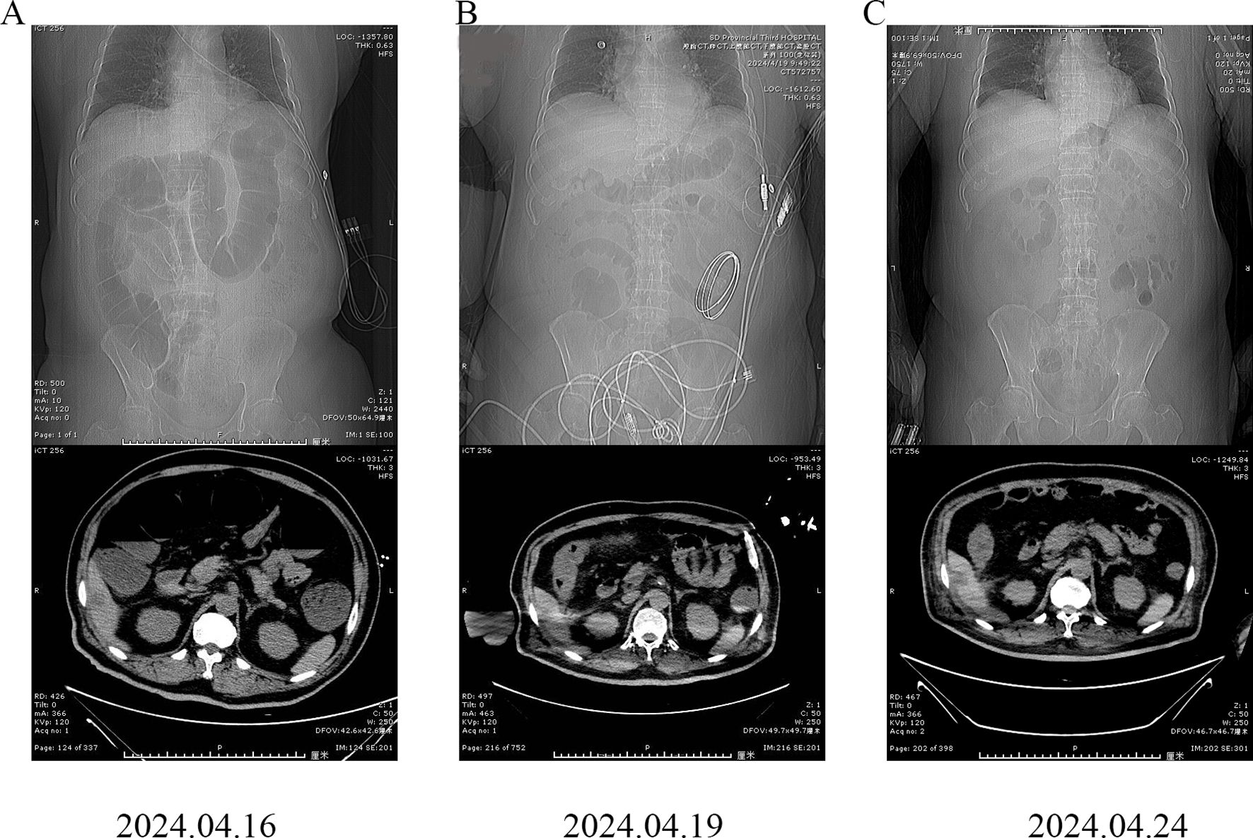 Three sets of medical images are displayed: each pair consists of an abdominal X-ray above and a corresponding CT scan cross-section below. The X-rays show the skeletal structure and some medical devices, while the CT scans reveal internal structures like organs.