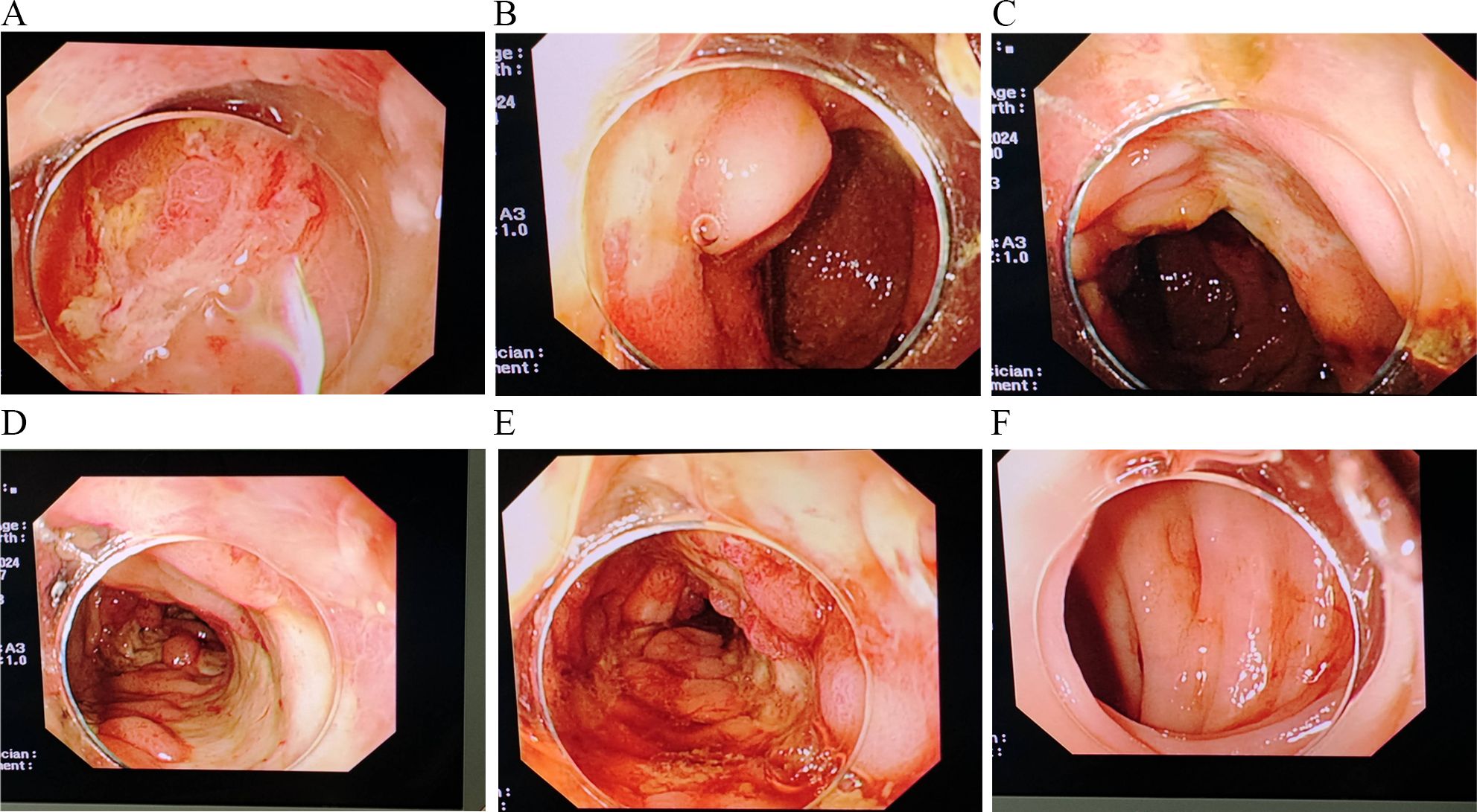 Colonoscopy images showing the interior of the colon. They display various stages and conditions of the colon, including inflamed and healthy tissue. Each image captures different areas and aspects of the colon, indicating potential abnormalities or normal findings through the lens of the scope.