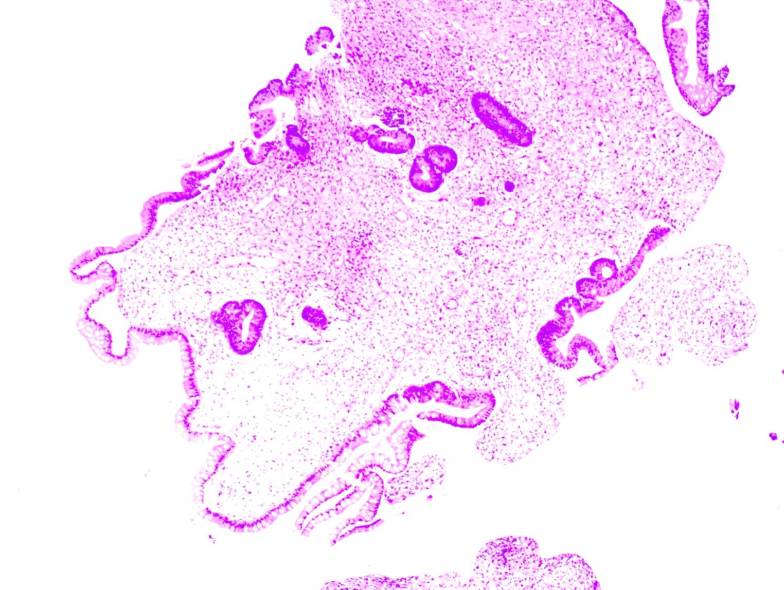 Histological slide showing a tissue sample stained in various shades of purple. The cellular structures are visible with dense areas and irregular shapes, indicating different tissue densities throughout the sample.