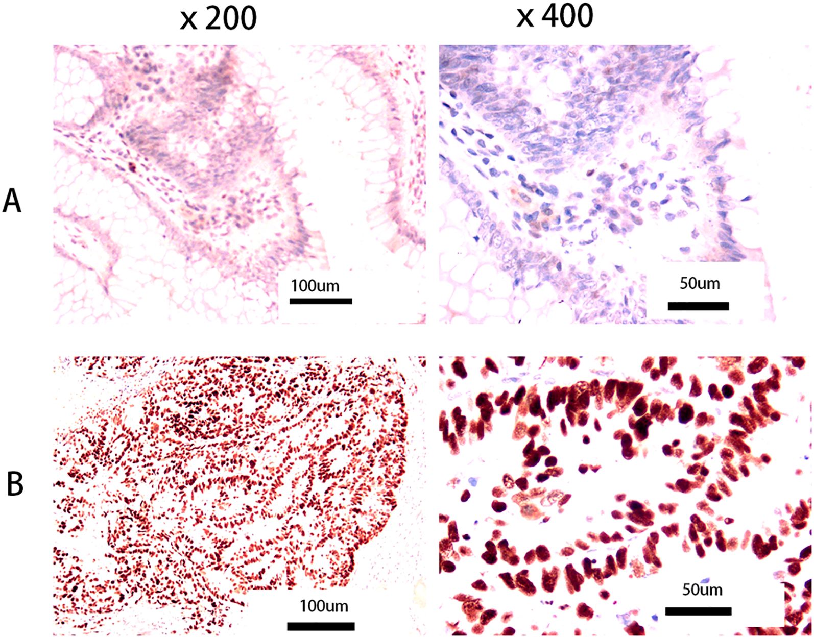 Microscopic images of tissue samples at two different magnifications, labeled A and B. Image A shows tissue at magnifications of 200x and 400x with nucleic structures visible; scale bars indicate 100 micrometers and 50 micrometers. Image B shows a similar tissue at higher magnification with more distinct, densely stained nuclei; scale bars also at 100 micrometers and 50 micrometers.