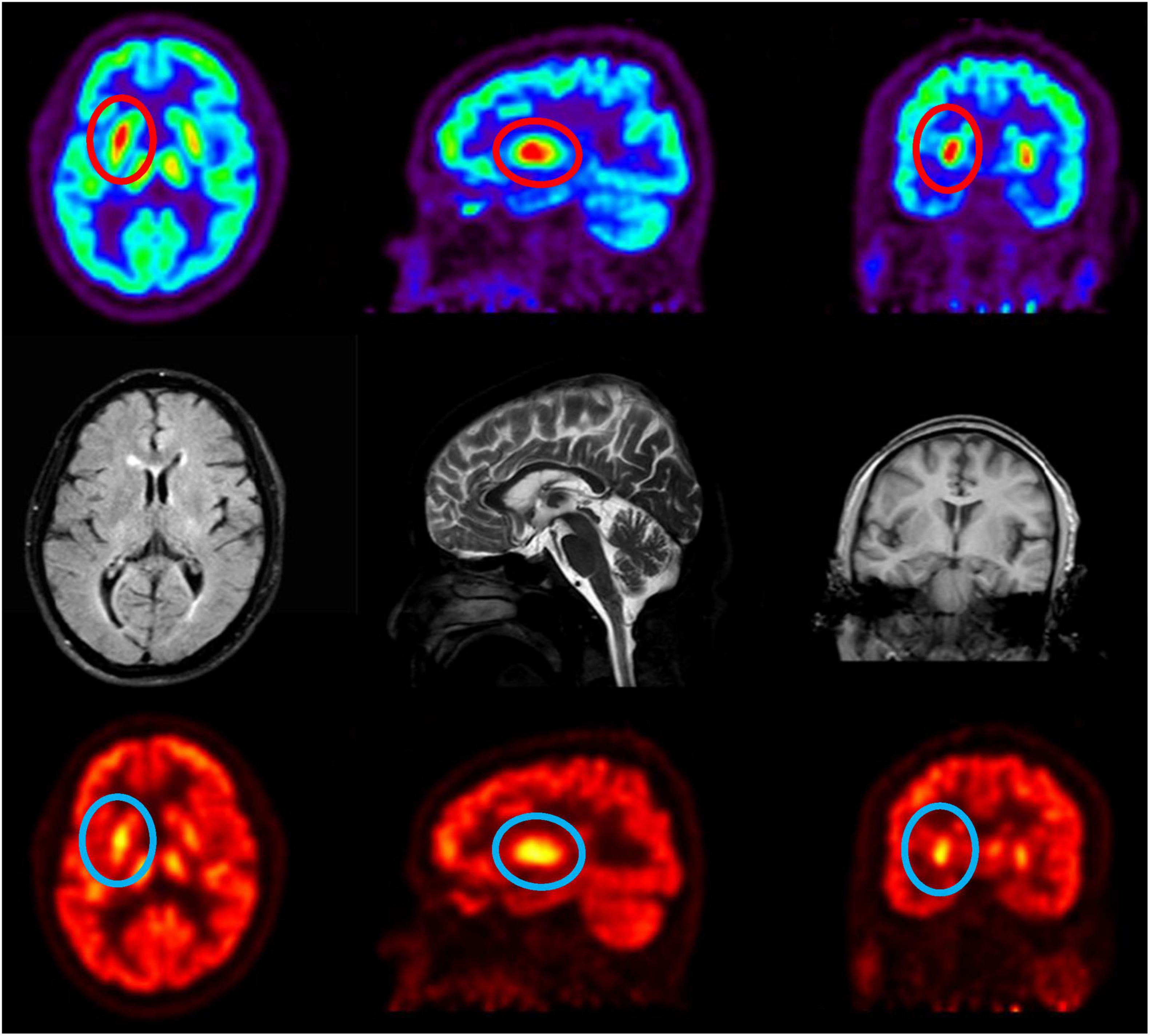 Composite medical imaging of the brain showing PET and MRI scans. The top row includes PET scans with bright color variations indicating brain activity. The middle row presents MRI scans with different cross-sections highlighting structural details. The bottom row also features PET scans with intense red regions signifying metabolic activity.